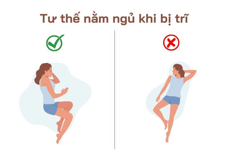 Tư thế nằm ngủ khi bị trĩ