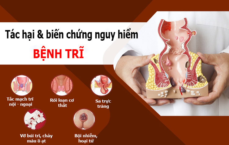 Bệnh trĩ thường xuất hiện ở độ tuổi nào