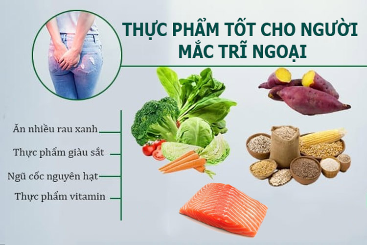 Điều trị bệnh trĩ ngoại độ 4