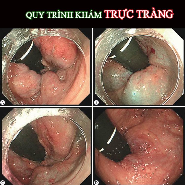 Khám bệnh trĩ như thế nào