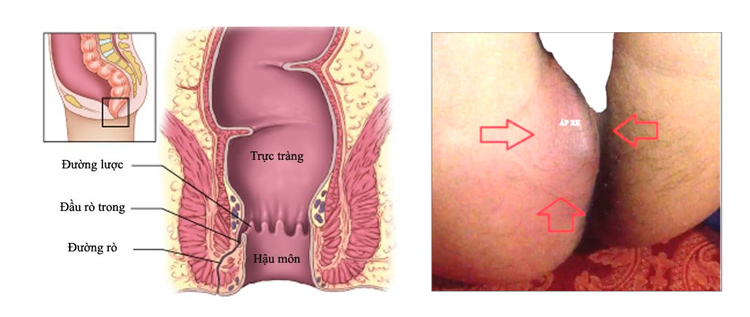 Khám bệnh trĩ như thế nào