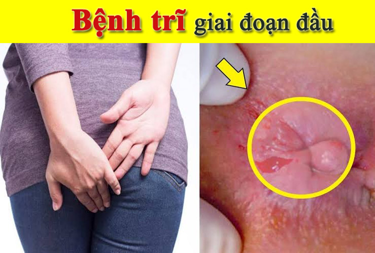 Bệnh trĩ giai đoạn đầu: Dấu hiệu và 8 cách chữa hiệu quả