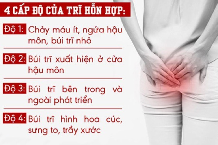 Các cấp độ của trĩ hỗn hợp