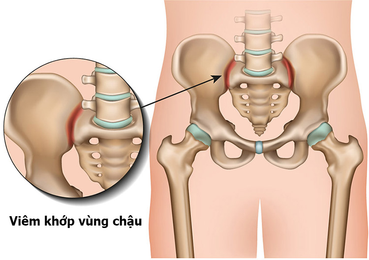 Bệnh trĩ có gây đau lưng không