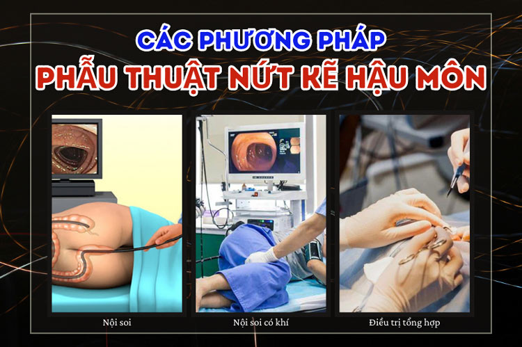 Phác đồ điều trị nứt kẽ hậu môn