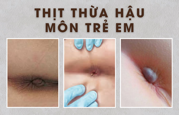 Hình ảnh thịt thừa hậu môn trẻ em