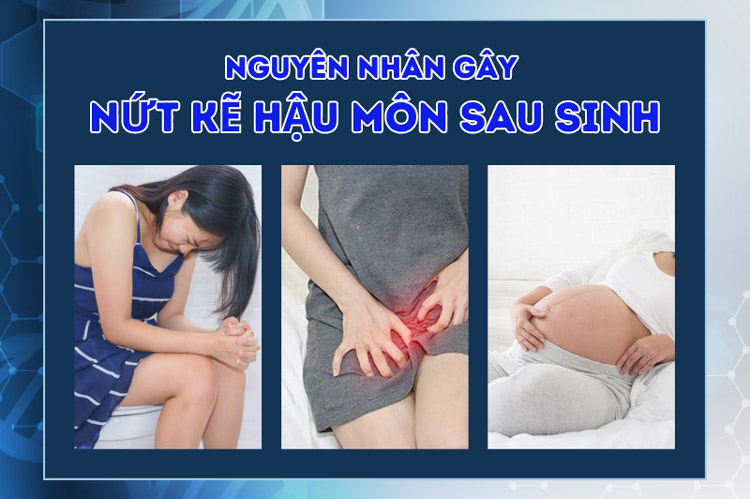 Nguyên nhân gây nứt kẽ hậu môn sau sinh