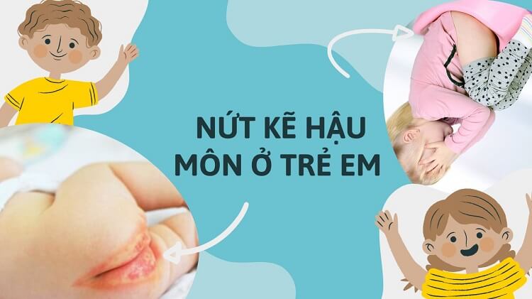 Nứt kẽ hậu môn ở trẻ em