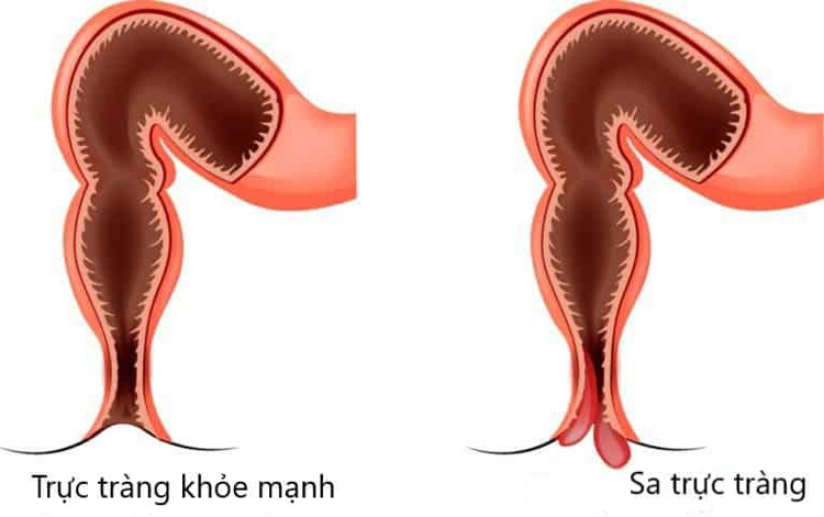 Bệnh trĩ có gây đau lưng không