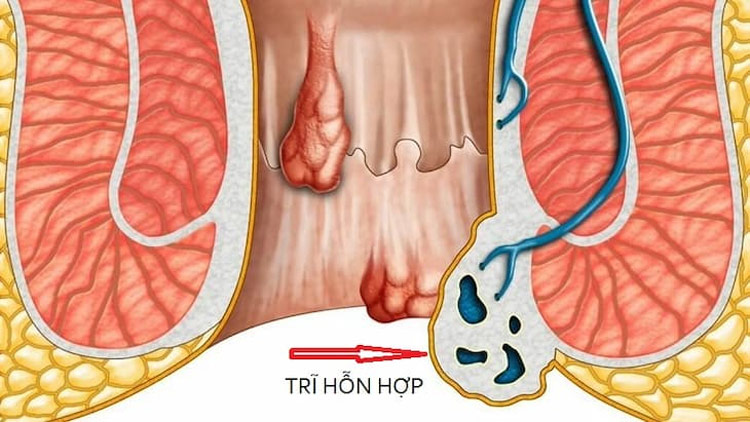 Trĩ hỗn hợp có nguy hiểm không