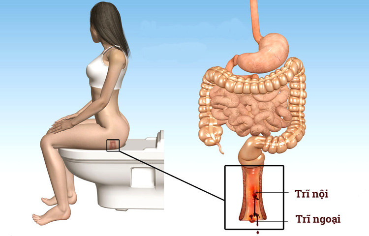 trĩ hỗn hợp