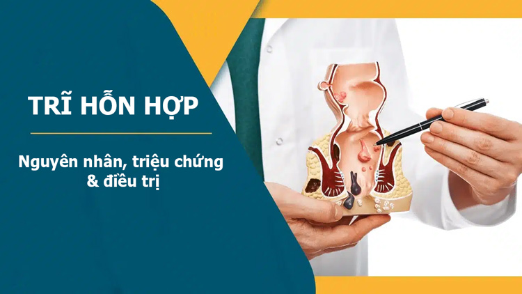 Bệnh Trĩ hỗn hợp: Nguyên nhân, triệu chứng & cách điều trị