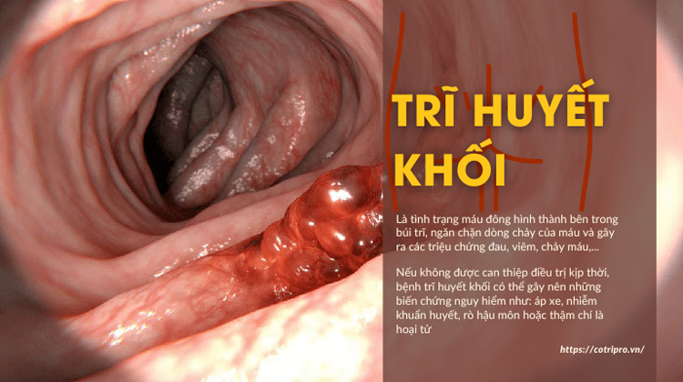 Trĩ huyết khối là gì