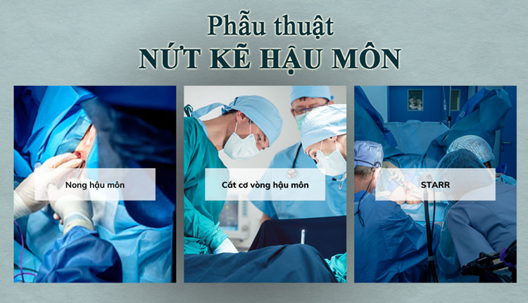 Phẫu thuật nứt kẽ hậu môn: Bao lâu thì lành? chăm sóc mổ