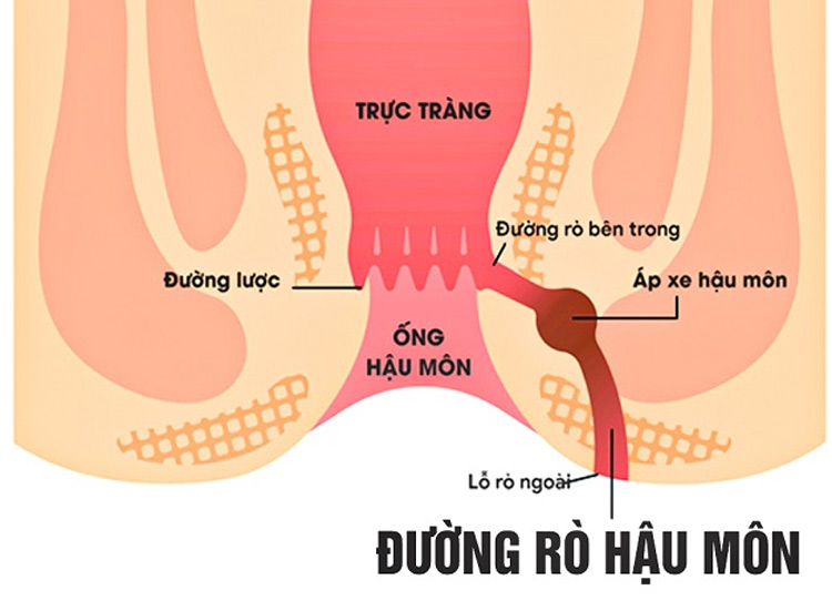 Đi ngoài ra máu và chất nhầy