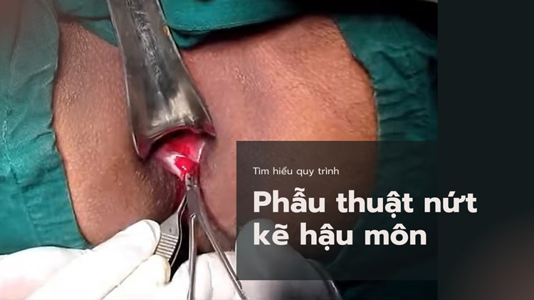 Phẫu thuật nứt kẽ hậu môn