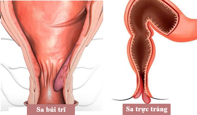 Trĩ và sa trực tràng