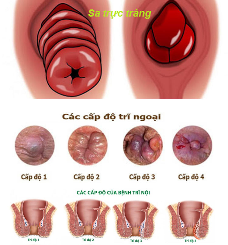 Trĩ và sa trực tràng