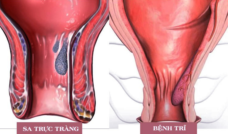 Phân biệt trĩ và sa trực tràng giống, khác nhau cực chuẩn